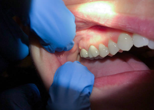 Best Knocked-Out Tooth (Avulsed Tooth) Treatment in Kaloko, HI